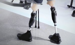 При парной (двусторонней) ампутации бедра, ходят на протезах и даже бегают