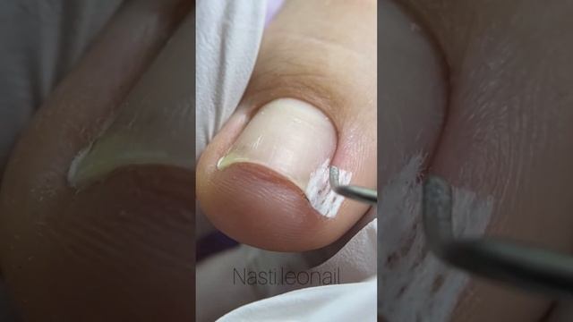 Тампонада ногтя / каполин /педикюр #nails #pedicure #pedicura #тампонада #skincare #каполин #педикю смотреть онлайн