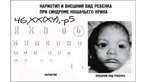 Синдром кошачьего крика. Синдром Лежёна