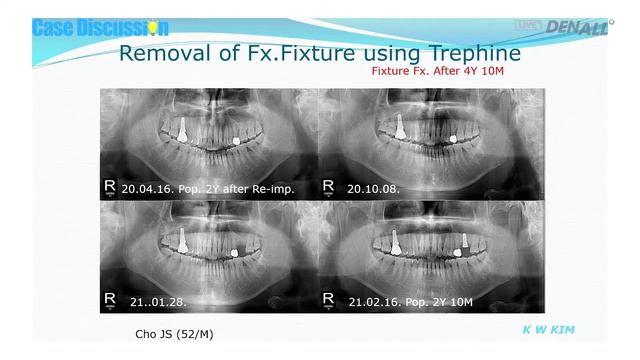 [Case Discussion] ep 29 Short Implants vs Long Implants смотреть онлайн