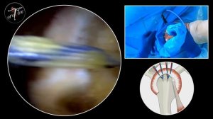 Кальцифицирующий тендинит сухожилия надостной мышцы