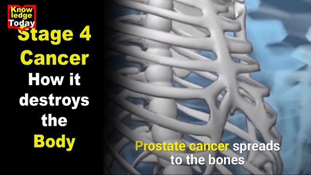 देखिये शरीर को कैसे तबाह कर देता है 4th Stage Cancer