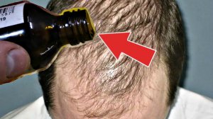Волосы вырастут даже на залысинах Вотрите это копеечное аптечное средство в голову.