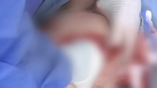 Dr Lee's HEAVIEST Lipoma Breaks The Internet! | Dr Pimple Popper смотреть онлайн