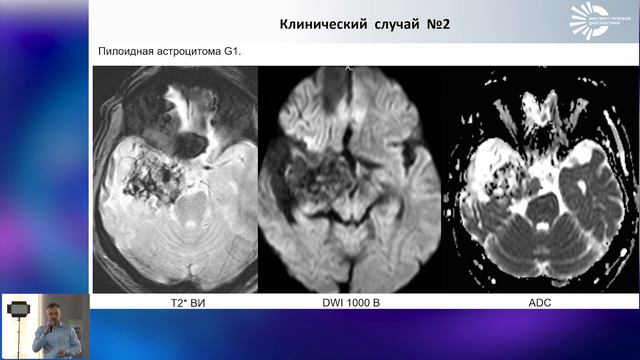 Rare cases of cerebral alveolar echinococcosis mimicking brain tumor Sergey Baryshnikov смотреть онлайн