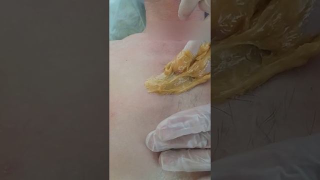 Обучение. Удаление волос на груди у мужчины. Training. Hair removal on the chest of a man. смотреть онлайн
