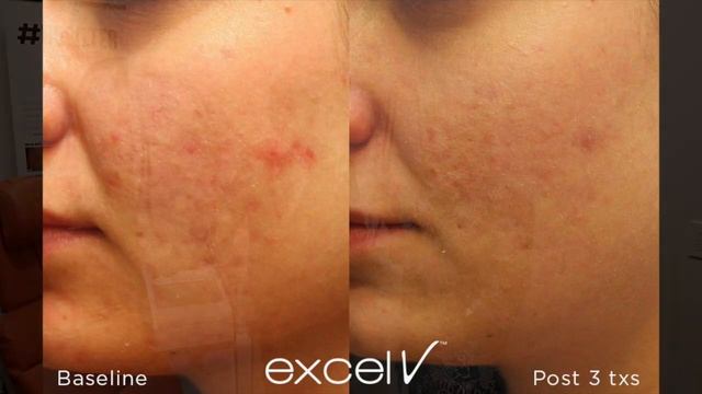 Laser Genesis (Excel V+) With Dr. Chobanian & Dr. Mihranian смотреть онлайн