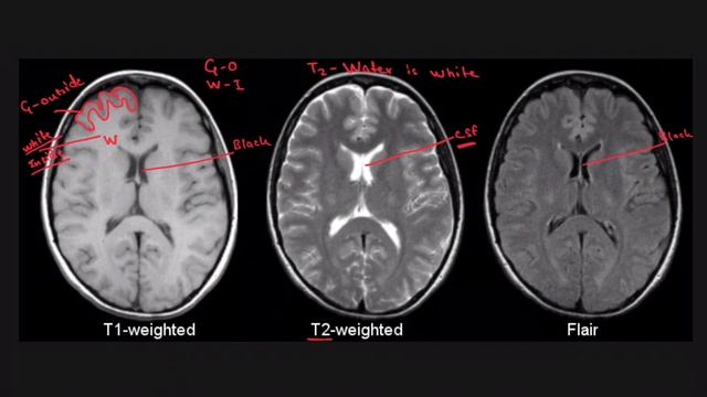 T1 MRI vs T2 MRI vs FLAIR MRI || MRI Brain || Radiology смотреть онлайн