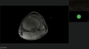 МРТ коленного сустава патология, которую мы часто «пропускаем», на примере клинических случаев