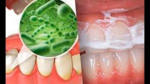 КАК ПРОСТО УДАЛИТЬ ЗУБНОЙ КАМЕНЬ