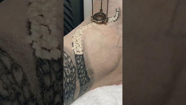 Лазерное удаление татуировки смотреть онлайн
