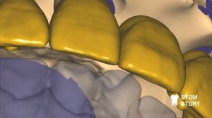 Изготовление балки с уступом ExoCad + B4D ( blender for dental)