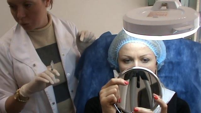 Princess Filler в носогубные складки