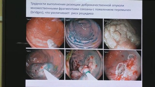 28 Кашин СВ Европейские рекомендации по лечению эпителиальных новообразований толстой кишки смотреть онлайн