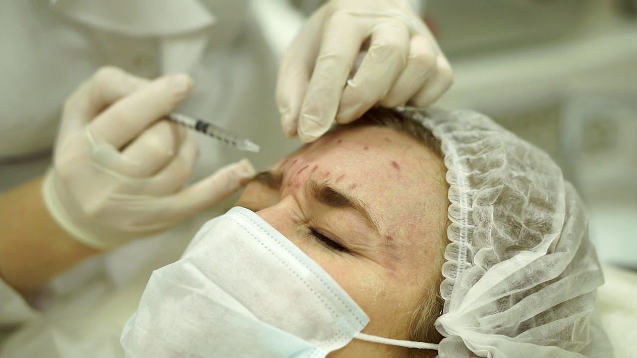 Ботулинотерапия. смотреть онлайн