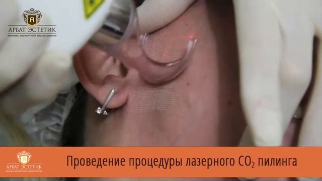 Смотрите отзыв о многоуровневовом омоложении: лазерный пилинг + игольчатый RF лифтинг смотреть онлайн