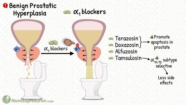 How Alpha Blockers Help in Benign Prostatic Hyperplasia? смотреть онлайн
