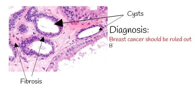 Fibrocystic breast- Causes, Symptoms and Treatment. Fibrocystic Breast Disease; смотреть онлайн