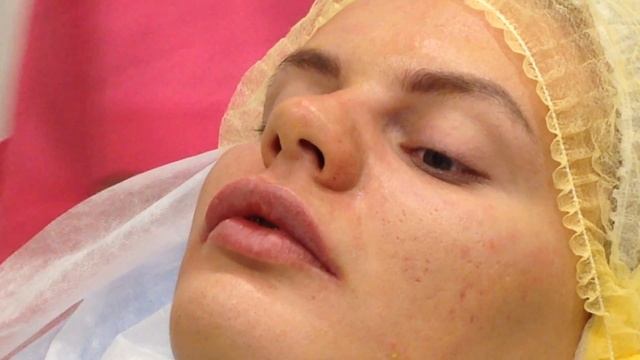 Меди Лайт Коррекция верхней губы филлером при ассиметрии смотреть онлайн