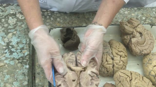 Головной мозг. Боковой желудочек. Ликвор смотреть онлайн