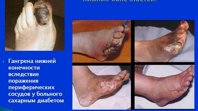 2 курс ФКП. Лекция на тему: "Сахарный диабет" смотреть онлайн