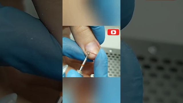 Жесткий ОНИХОЛИЗИС ногтей на руках!? Зачистка онихолизиса #shorts смотреть онлайн