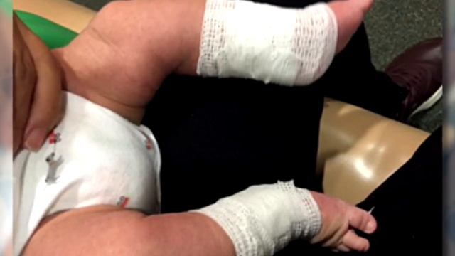 Jonas' Clubfoot Journey смотреть онлайн