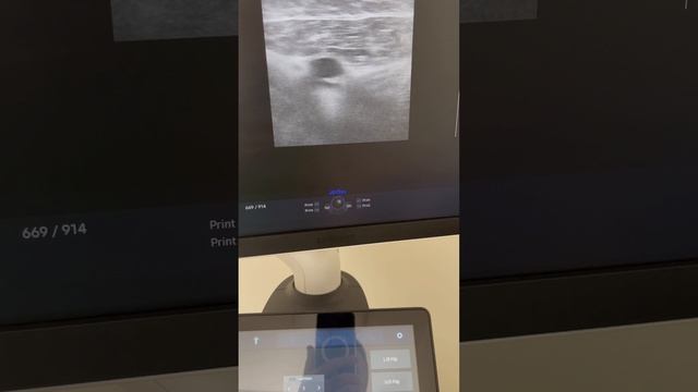 Вылечили тромбоз. Как вылечить тромбоз? Тромбы на ноге. Флеболог Москва. Тромб лечение смотреть онлайн