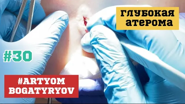 30. БОЛЬ при гнойной атероме! Лучше удалить