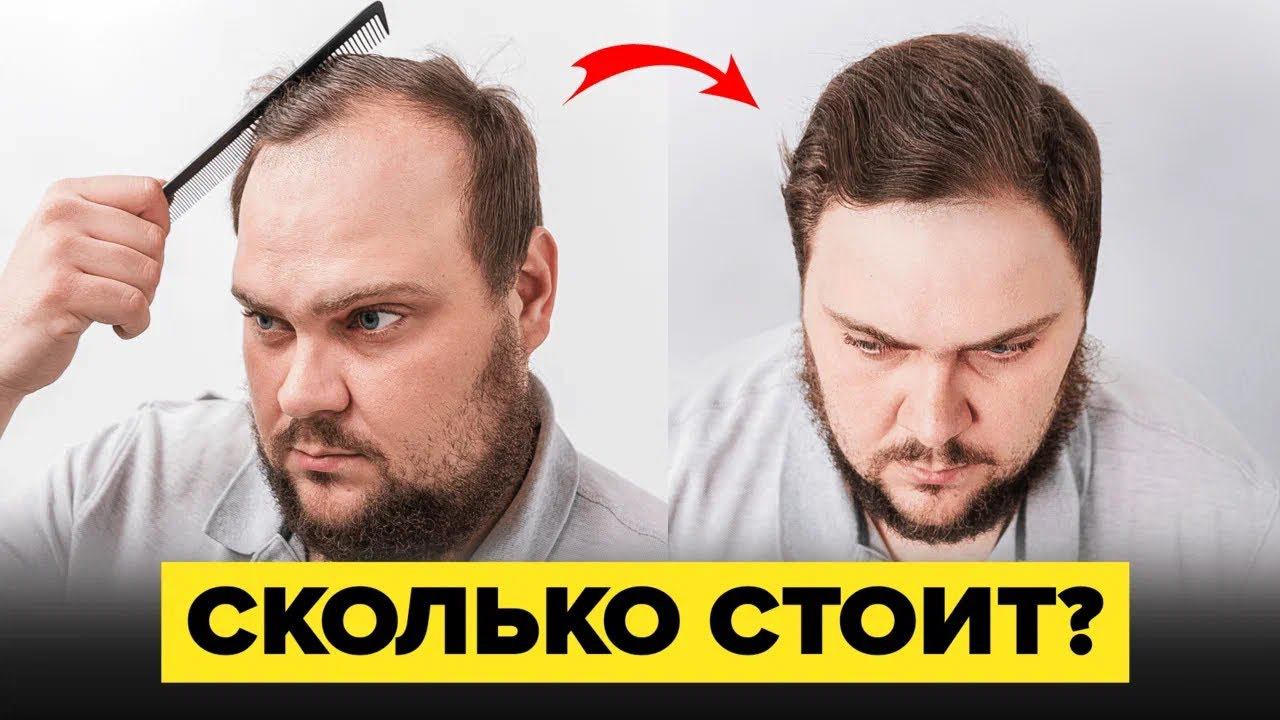 Пересадка волос "КАКАЯ ЦЕНА"? смотреть онлайн