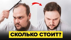 Пересадка волос "КАКАЯ ЦЕНА"?