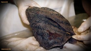 Рак Лёгких Первые Симптомы