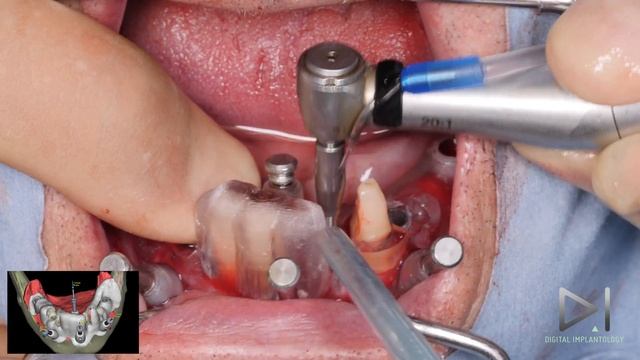 Nobel Biocare: The evolution of the All-on-4® treatment concept смотреть онлайн