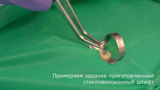 "Восстановление культи зуба под коронку с использованием стекловолоконного штифта" смотреть онлайн