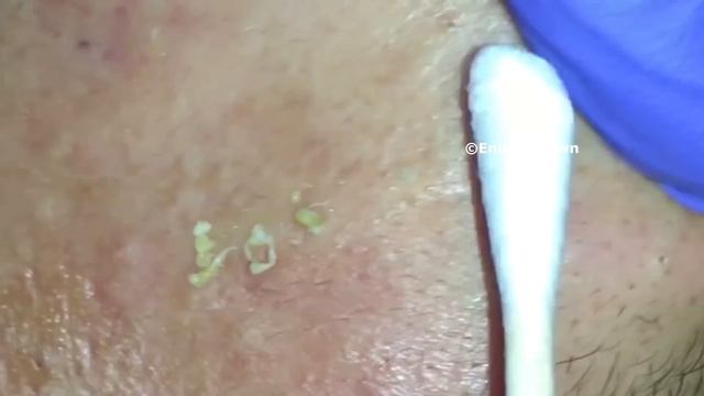 "K's" Best Blackhead Extraction Compilation Part #2 смотреть онлайн