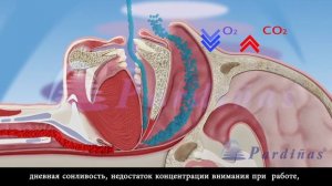 Апноэ во сне ©