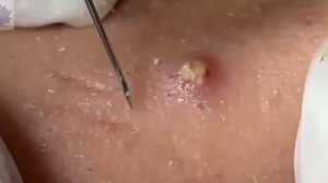 подборка выдавливания прыщей 12 II выдавливание прыща