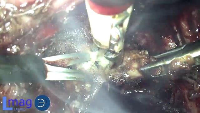 Агрессивная форма эндометриоза с двусторонним поражением яичников смотреть онлайн