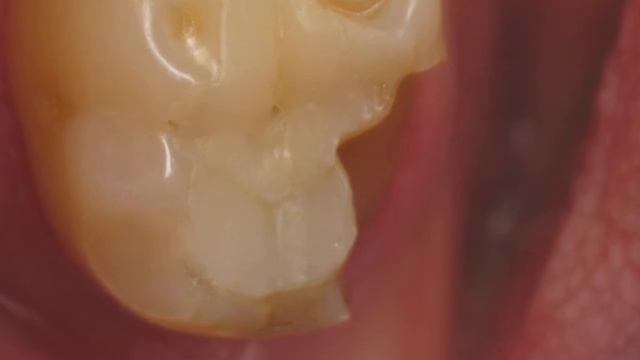 Ожог десны: виды, лечение, фото. Что делать при термическом и химическом ожоге десны. смотреть онлайн