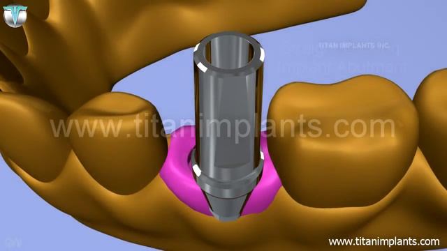 Open Tray and Final Restoration Technique for ASTRA TECH Compatible TX System смотреть онлайн