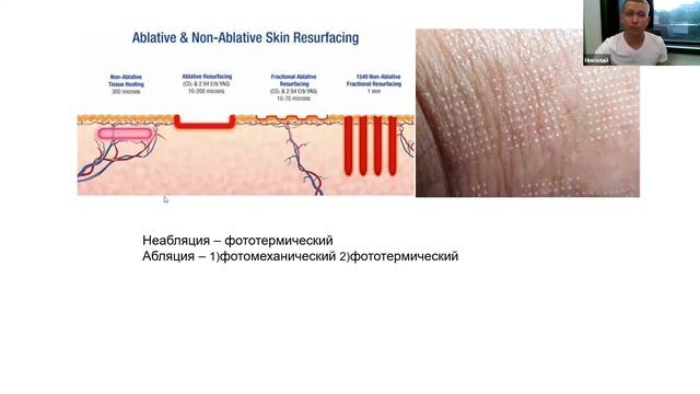 ФИЗИКА ЛАЗЕРА. «Эрбиевые и CO2 лазеры. смотреть онлайн