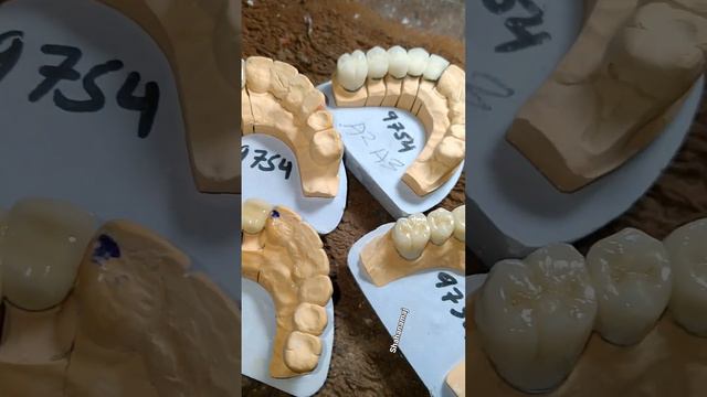 ceramic crowan with glaze teeth p f m смотреть онлайн
