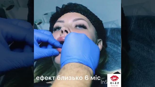 Збільшення губ біогель смотреть онлайн