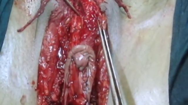 GENITOPLASTIA FEMENIZANTE DR. MACMILLAN смотреть онлайн