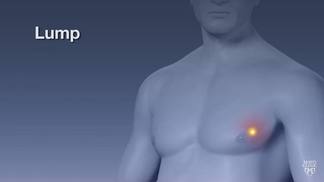 Mayo Clinic Minute: Breast cancer strikes men, too
