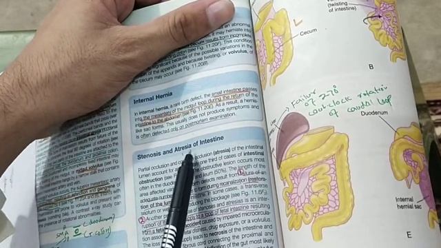 CLINICAL OF MIDGUT |GIT DEVELOPMENT PART8| #mbbs #embryology смотреть онлайн