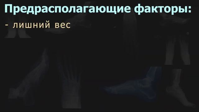 БОЛЬ В ПЯТКЕ. Пяточная шпора, плантарный фасциит. Причины, симптомы, диагностика и лечение. смотреть онлайн