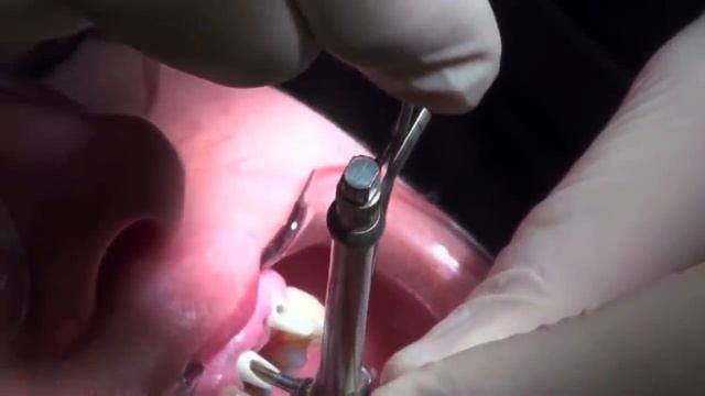 Установка моста на зубные импланты