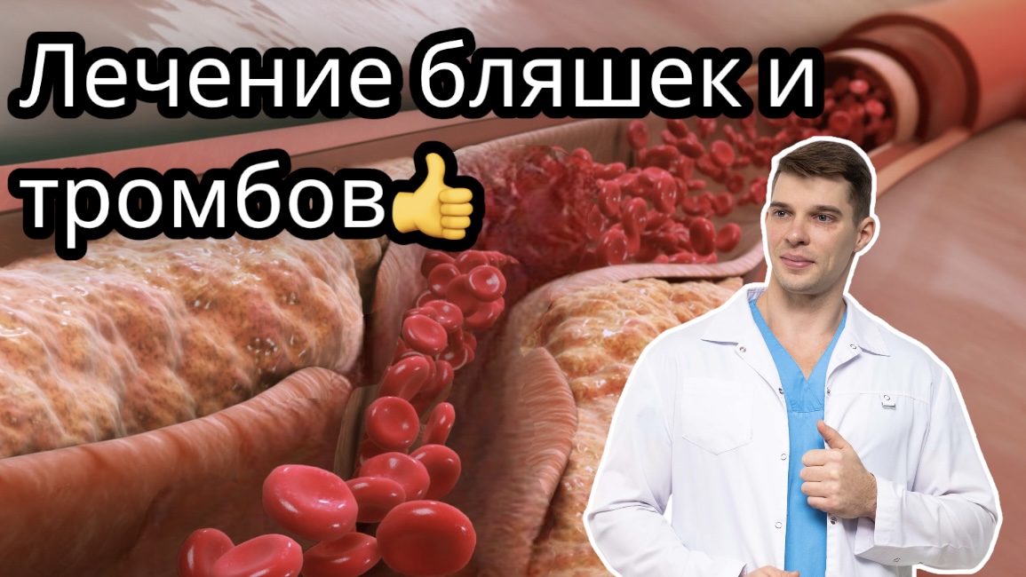 Лечение БЛЯШЕК и ТРОМБОВ, атеросклероз, профилактика, диагностика Врач о препаратах смотреть онлайн