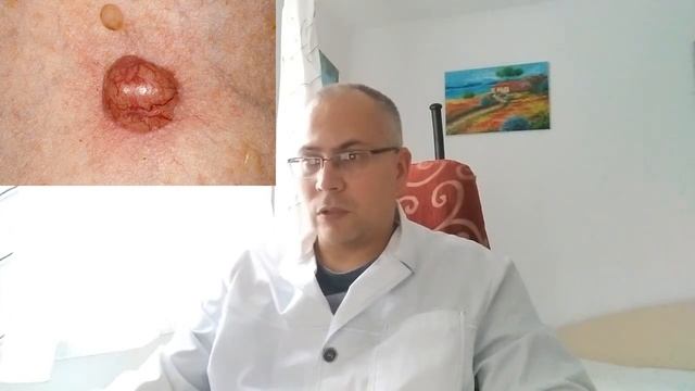 Базалиома - видео о базальноклеточном раке кожи смотреть онлайн